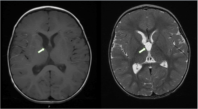 MRI
