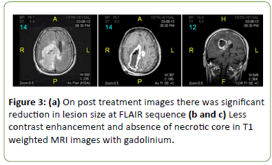 Tumefactive Neuro Behcetaƒa A A A A S Disease A Case Report And Review Of The Literature Insight Medical Publishing