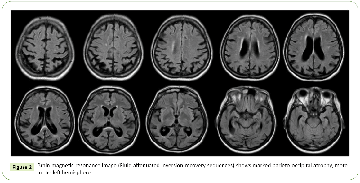 A Case of Posterior Cortical Atrophy with Complex Set of Symptoms and