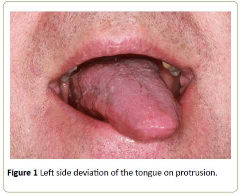 jneuro-Left-side-deviation-tongue-protrusion
