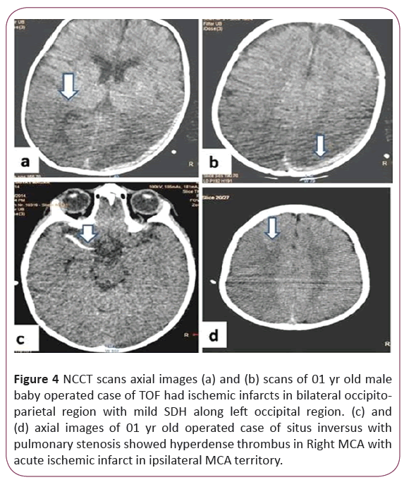 Ct Findings Of Early Post Operative Neurological Complication Of Cardiovascular Surgeries Insight Medical Publishing