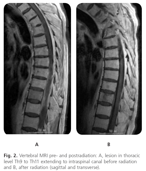 jneuro-Vertebral-MRI