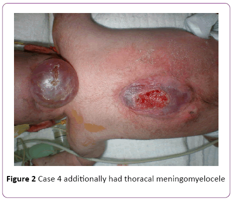 jneuro-thoracal-meningomyelocele