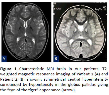 Molecular Analysis Of Pank2 Gene In Two Thai Classic Pantothenate Kinase Associated Neurodegeneration Pkan Patients Insight Medical Publishing Molecular Analysis Of Pank2 Gene In Two Thai Classic Pantothenate Kinase Associated Neurodegeneration Pkan Patients Insight Medical Publishing